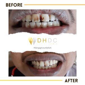 promo scaling gigi murah di jakarta