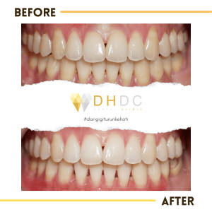 promo bleaching gigi terdekat di tangerang