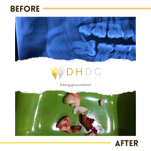 mencabut gigi bungsu impaksi