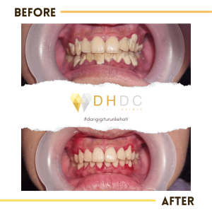 promo scaling gigi murah di depok