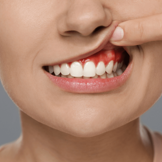 Terjadi Pembengkakan Gusi