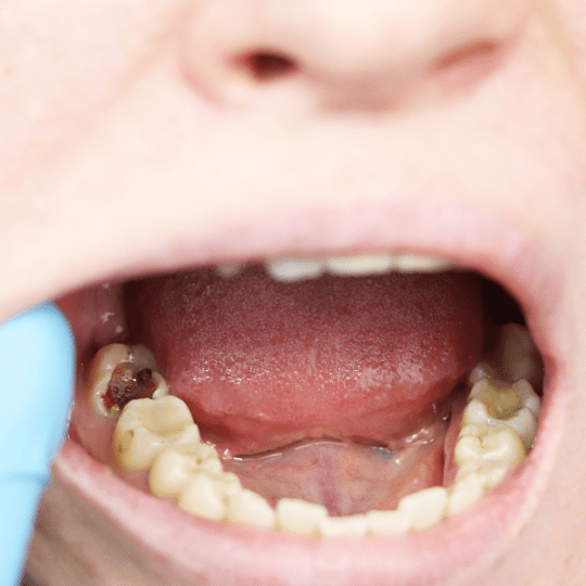 Munculnya Gigi Berlubang