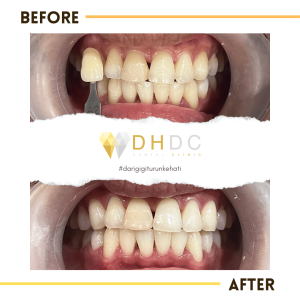 promo bleaching gigi terdekat di depok