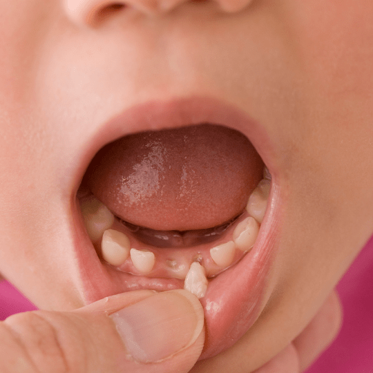 Mengalami Gigi Goyang