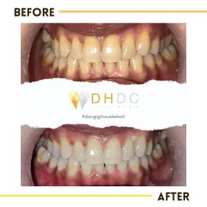 bleaching gigi murah di depok