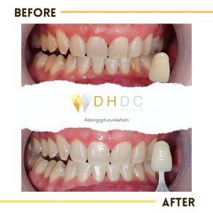 promo bleaching gigi terdekat di tangerang