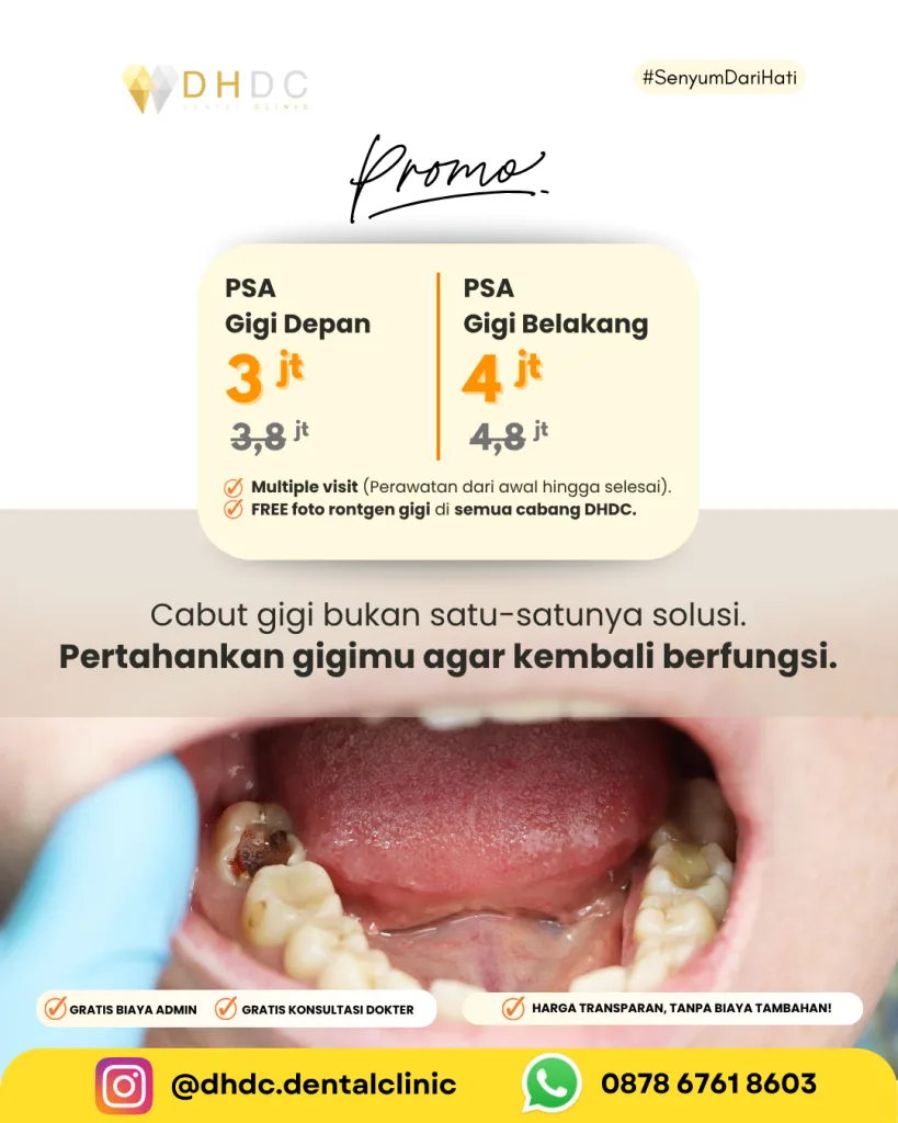 promo perawatan gigi berlubang dan rusak murah terdekat di jakarta