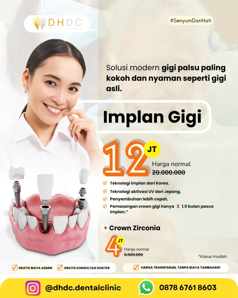 promo pasang implan gigi palsu terdekat di jakarta