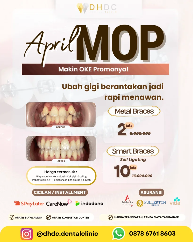promo pasang behel gigi murah terdekat di depok