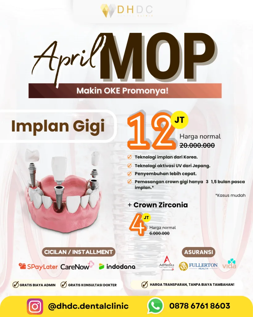promo pasang implan gigi palsu terdekat di jakarta