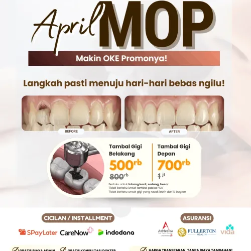 promo tambal gigi belakang murah terdekat di depok